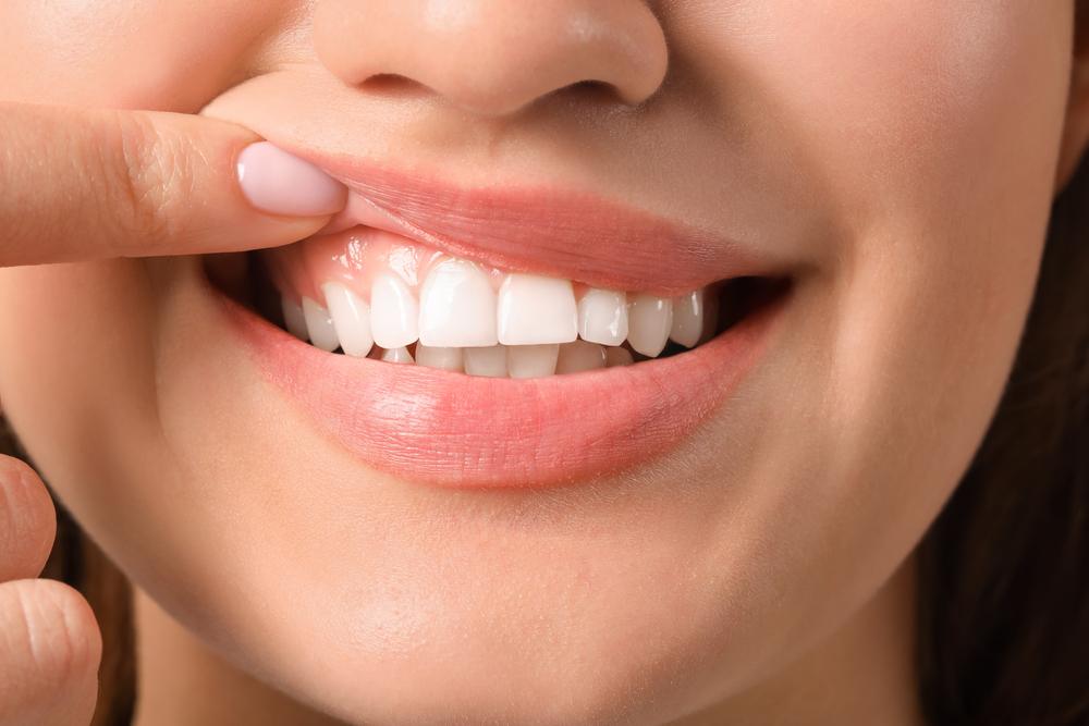 image 1 gingivitis