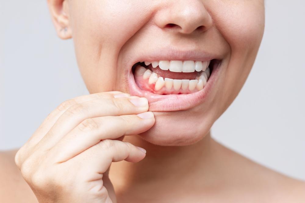 What Is Gingivitis? Signs, Symptoms, and Treatment Options