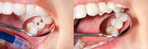 What Are Composite Fillings? A Natural-Looking Solution for Cavities