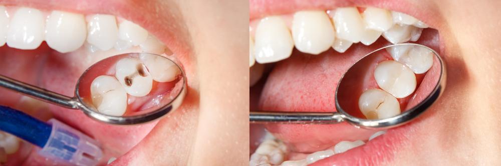 What Are Composite Fillings? A Natural-Looking Solution for Cavities
