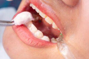 Fluoride Treatment for Stronger Smiles