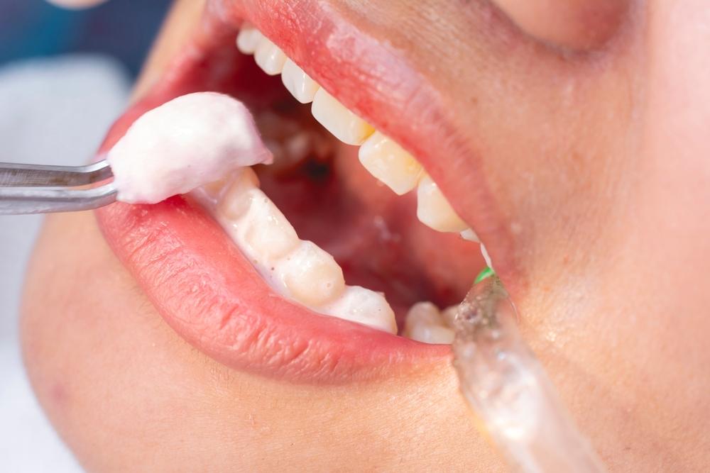 Fluoride Treatment for Stronger Smiles