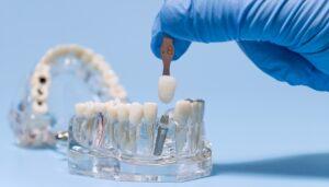 Dental Implants for a Stronger, Confident Smile